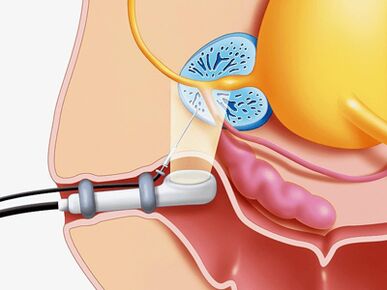 Prostate needle biopsy
