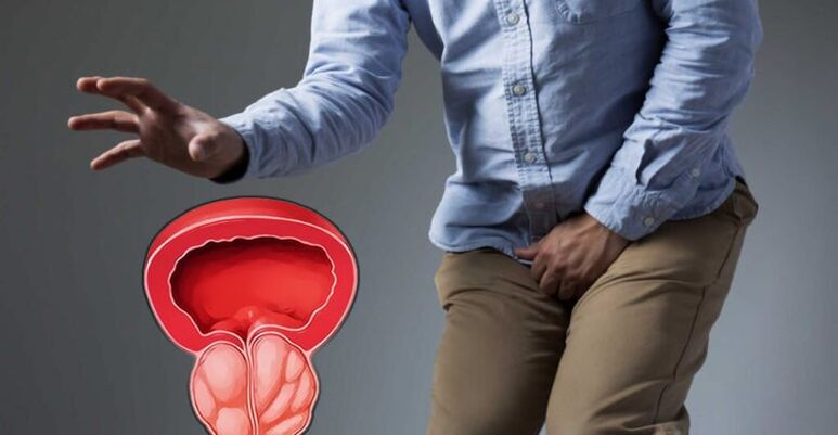 Prostatitis and prostate adenoma prevention